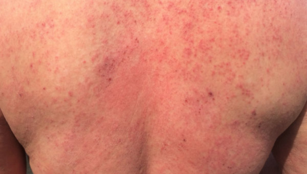 Eczema gây nổi ban diện rộng trên lưng người lớn 